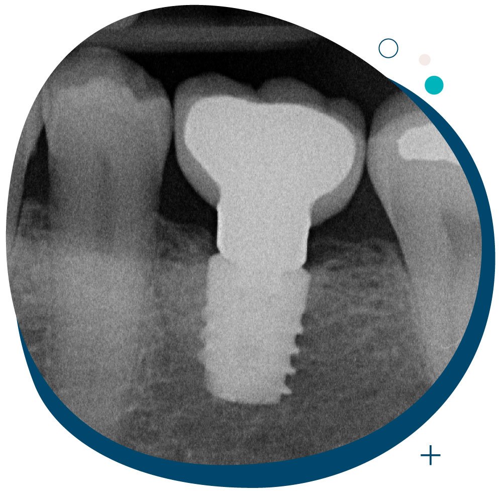 Clínica dental El Pilar - Implantologia oral